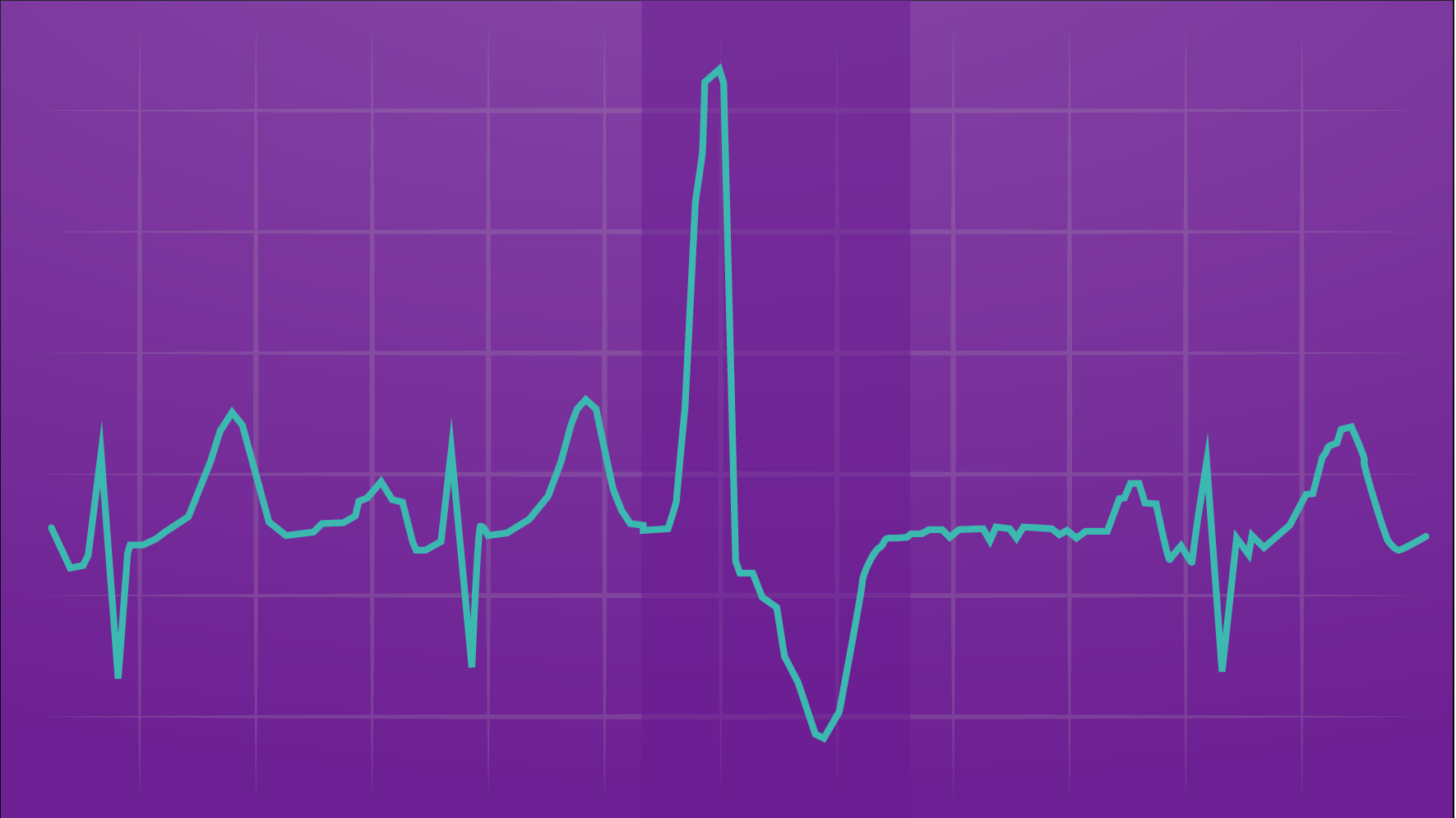 心电图打印图显示室性早搏