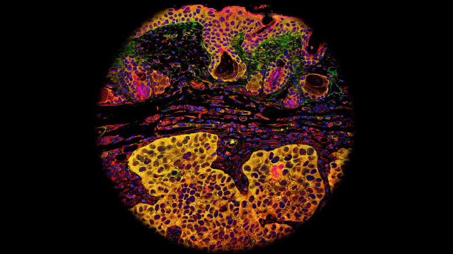 显微镜下癌症肿瘤细胞的细节
