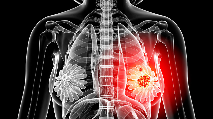 骨骼图形与辐射从左乳房区域辐射