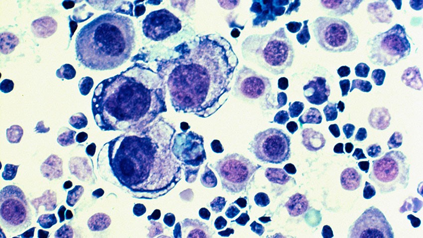 紫色和蓝色的转移性乳腺癌细胞图像。