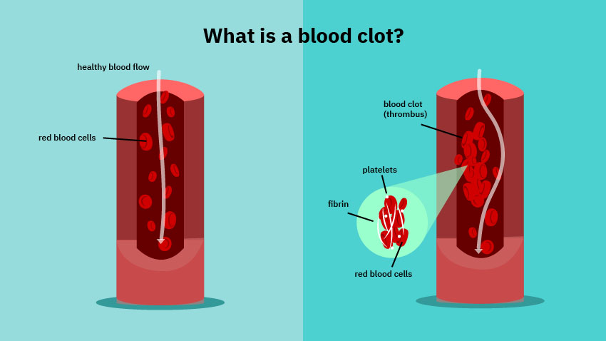 什么是血凝块图像，说明健康的血液流动，红细胞，血块，血小板，纤维蛋白和红细胞