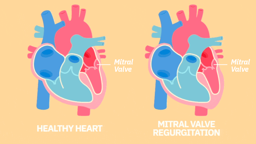 健康心脏跳动和二尖瓣反流的动图