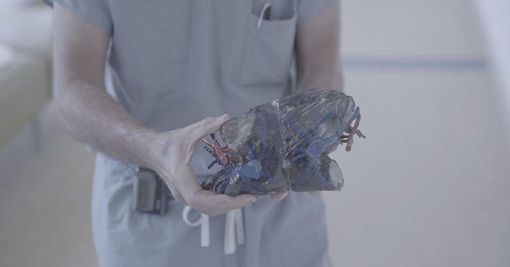 3D打印的女孩肝脏模型